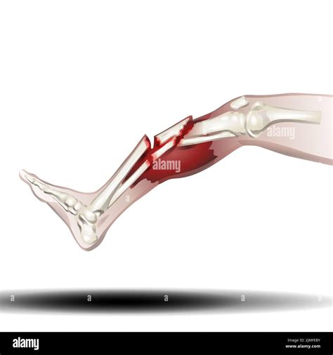 Leg Bone Fracture - Illustration on White Background Stock Photo - Alamy