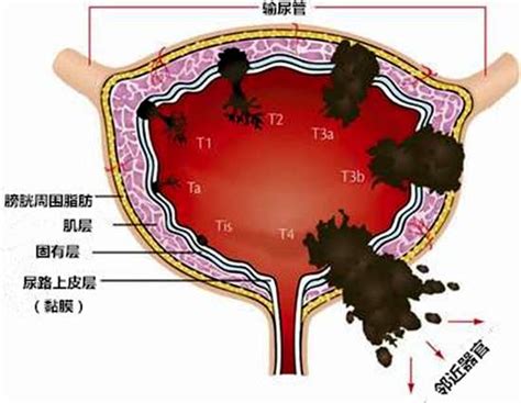 膀胱癌是如何检查出来的 这篇文章告诉你详细过程 知乎