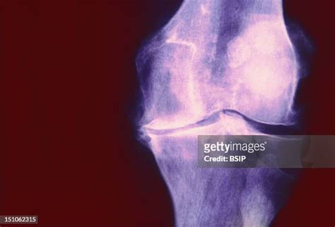 Degenerative Joint Disease Photos And Premium High Res Pictures Getty