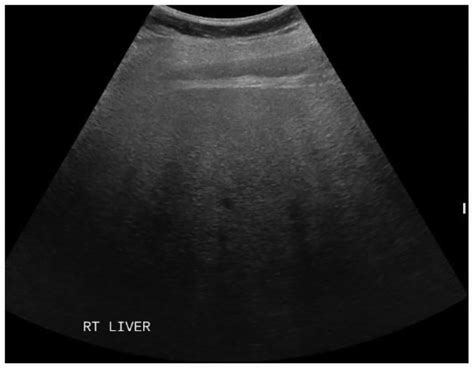 Quantitative Hepatic Fat Quantification In Non Alcoholic Fatty Liver