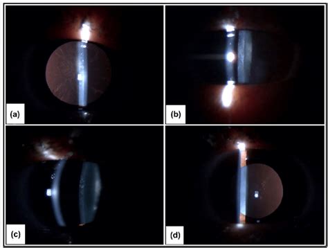 Posterior Subcapsular Cataract