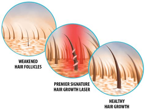 Effective Hair Growth Laser Treatment In Malaysia Premier4him