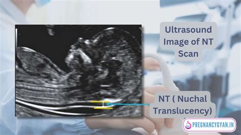 Nt Scan In Pregnancy