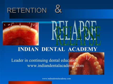 Splinting Part I Certified Fixed Orthodontic Courses By Indian Denta