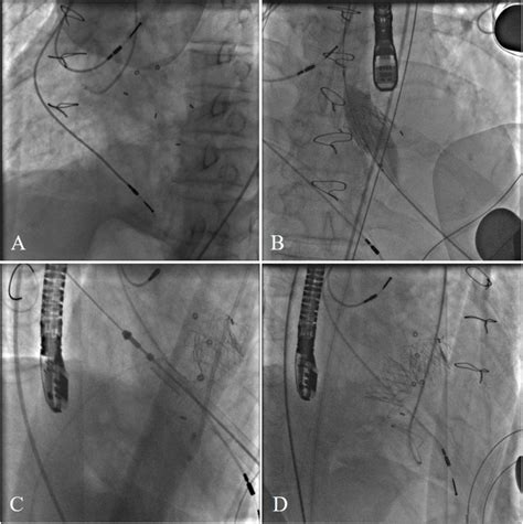 A The Annulus Of The Medtronic Mosaic Aortic And Mitral Bioprosthesis