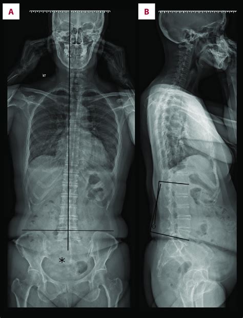 Full Spine Radiographs The Anteroposterior View A Shows An Abnormal Download Scientific