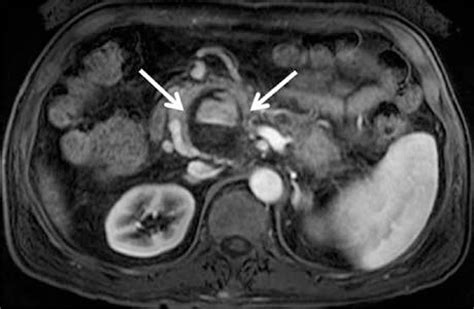 SciELO Brasil A Pancreatic Hemorrhagic Pseudocyst With Pseudoaneurysm