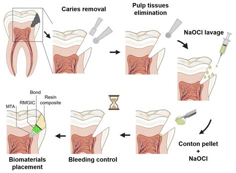 Full Pulpotomy Bests Partial Pulpotomy For Managing Of Spontaneous