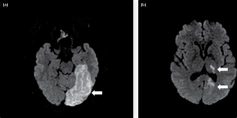 Posterior Cerebral Artery Distribution