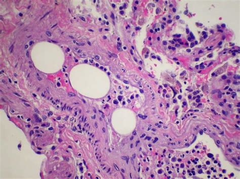 Fat Embolism Teachmesurgery