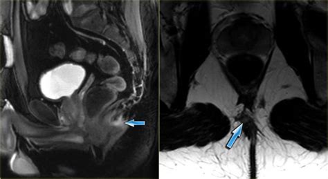 Pilonidal Cyst Mri