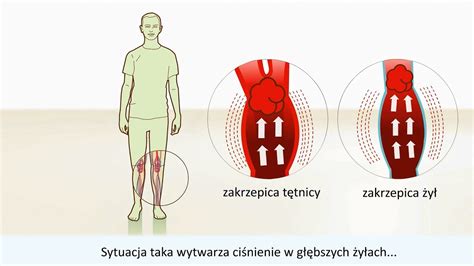 Zakrzepica Przyczyny I Leczenie Youtube