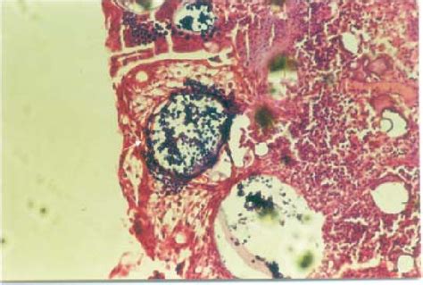 Tissue staining with haematoxylin and eosin showing characteristic ...