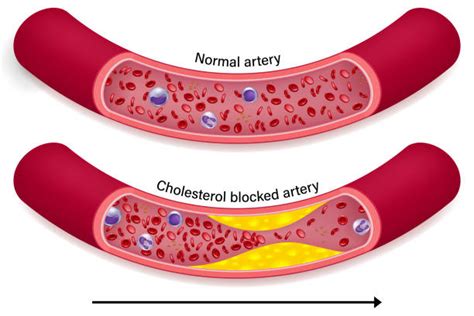 740 Clogged Artery Stock Illustrations Royalty Free Vector Graphics