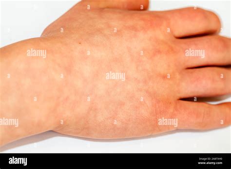 Erythema ab igne or heat dermatitis also known as hot water bottle rash ...