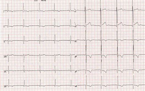 Interpretation Of T‐wave Inversion In Physiological And Pathological Conditions Current State