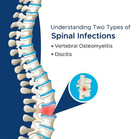 A Brief Guide On Understanding Two Types Of Spinal Infections By