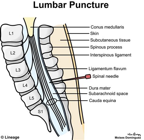 Lumbar Puncture - Neurology - Medbullets Step 1