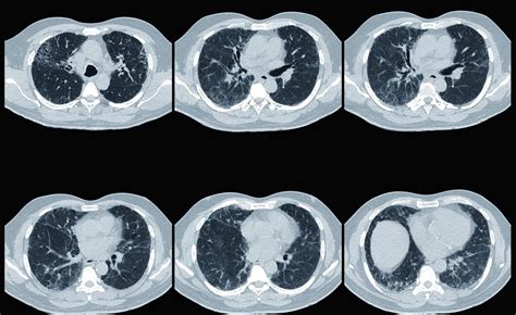 CT Honeycombing In Interstitial Lung Disease Linked To Higher Mortality