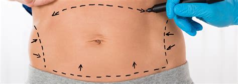 See How A Lower Body Lift Can Remove Excess Skin On The Body Cosmetic