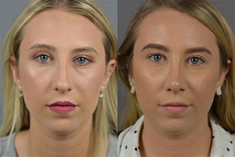 Nose Surgery Before After Patient Dr Marotta