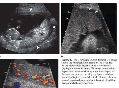 Placenta Percreta Ultrasound 2464 The Best Porn Website