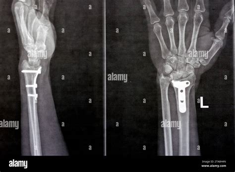 Radiografía simple que muestra una fractura reciente de fisura en la