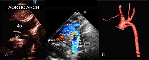 Scielo Brasil Double Lumen Aortic Arch Persistence Of The Fifth