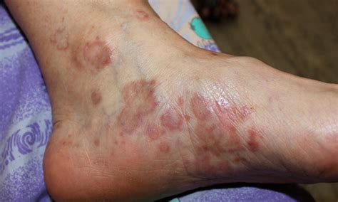 Lichen Planus Skin Disease