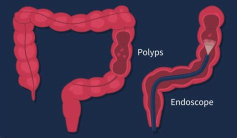 Polyps Vs Diverticula Colon Polyps And Diverticulitis Differences And Relationship