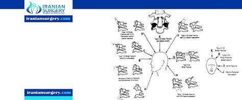 Cervical Fracture Types - Iranian Surgery