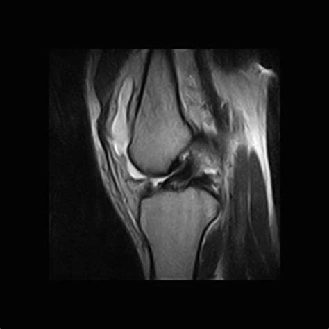 A. Sagittal MRI image showing proximal ACL tear. | Download Scientific ...