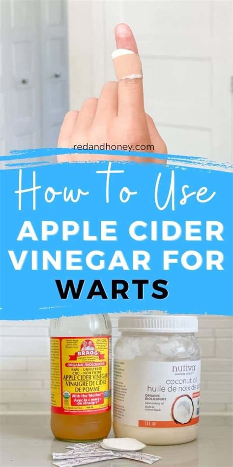 How To Use Apple Cider Vinegar For Warts Effective Home Remedy