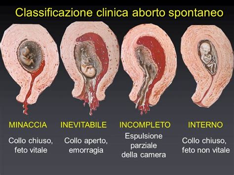 Aborto Spontaneo Perch Succede Retehphitalia It Blog Di Salute E