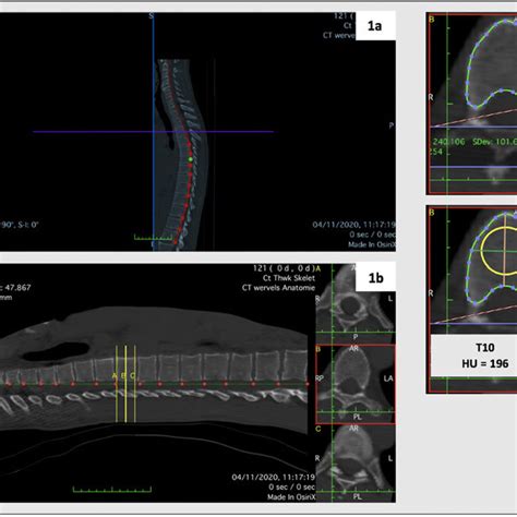 Methodology Of Hounsfield Units Hu Measurement A Using A Download Scientific Diagram