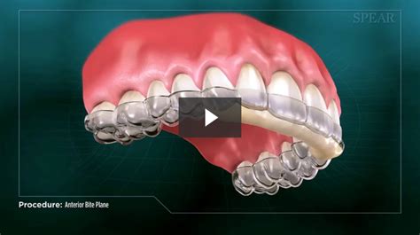 Anterior Bite Plane - Cosmetic Dentistry