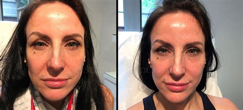 Dermal Fillers Before And After Photos Dr Jerome Edelstein Toronto On