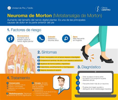 Neuroma de Morton todo lo que necesitas saber y cómo tratarlo