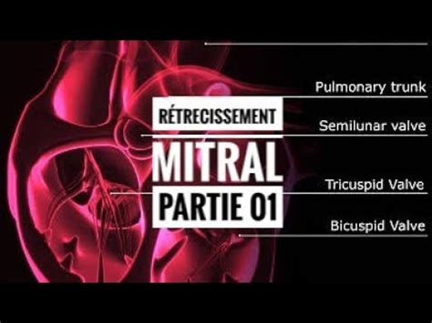 R Trecissement Mitral Partie Youtube