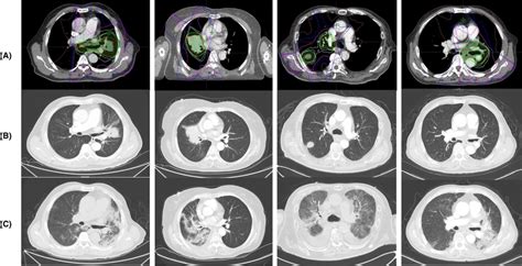 Representative CT images of four patients with symptomatic pneumonitis ...