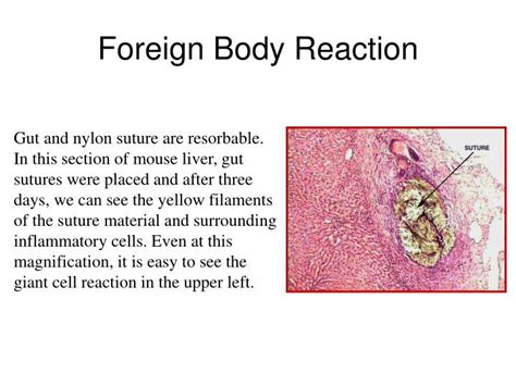 PPT - Periapical Granuloma PowerPoint Presentation - ID:4604077