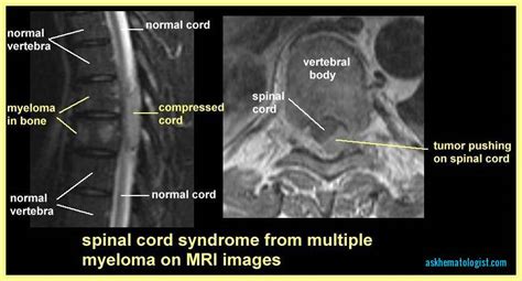 Multiple Myeloma - Ask Hematologist | Understand Hematology