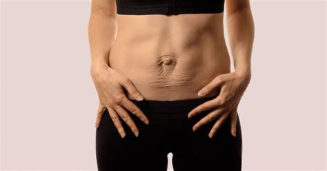 Diastasis Recti Explained Symptoms Treatment