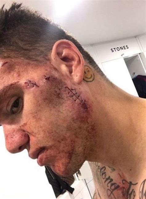 Así Quedó El Rostro De Ederson El Arquero Del Manchester City Que Preocupó Al Mundo Del Fútbol