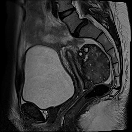 Ovarian Torsion Radiology Case Radiopaedia Org