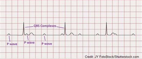 Third-Degree (Complete) AV Heart Block ECG Review