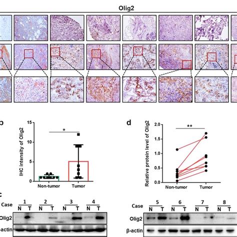 Olig Was Overexpressed In Lung Cancer Tissues A The Representative