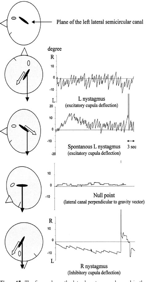 Figure 17 From Pathophysiology Of Nystagmus In Benign Paroxysmal