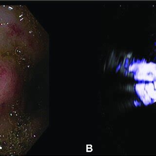 A Eus Showing Positive Doppler Signal B Egd Showing Large Blebs With