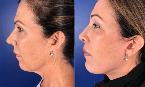 Chin Augmentation Procedure Houston Chin Implants Cilento Facial